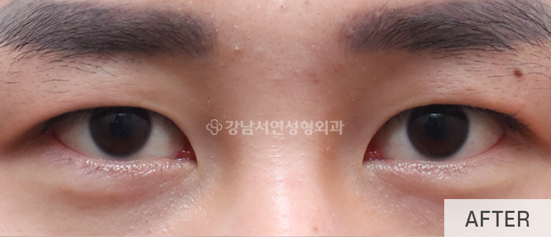 남자눈성형, 무쌍눈매교정