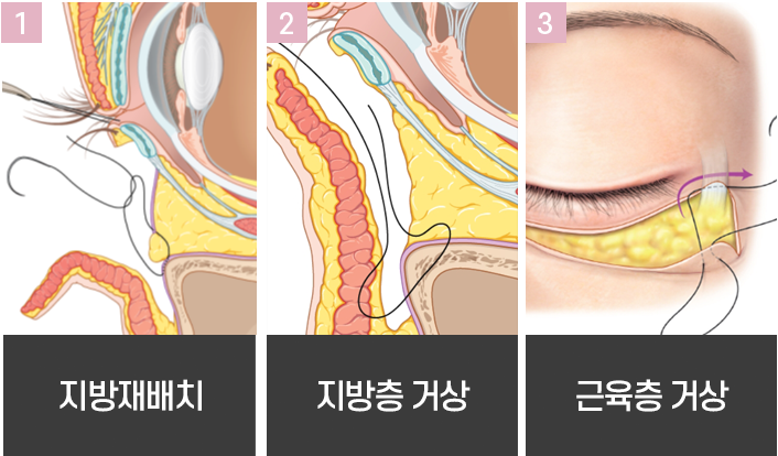 눈밑지방재배치 수술, 하안검 수술 에 대해 알아봅시다. 사진 5