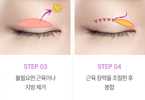 눈매교정 수술로 아름다운 눈모양 만들기 사진 7
