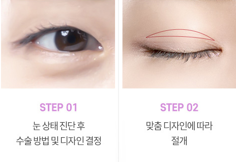 눈매교정 수술로 아름다운 눈모양 만들기 사진 6
